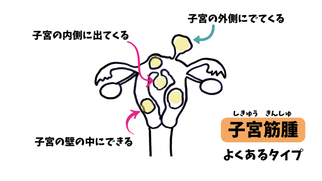 子宮筋腫のイラスト